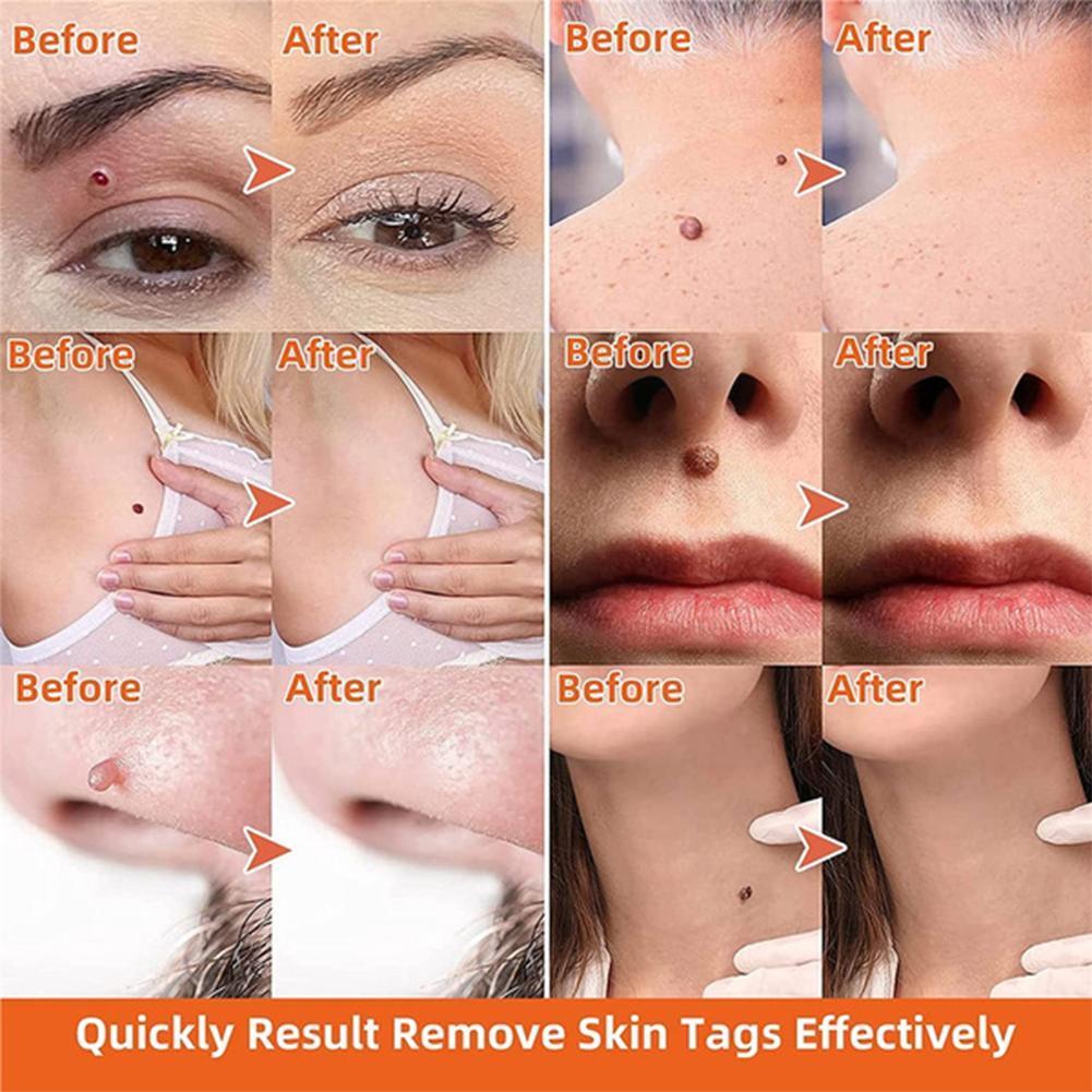 Skin Tag Remover | One Hand Micro Band Ligation Kit