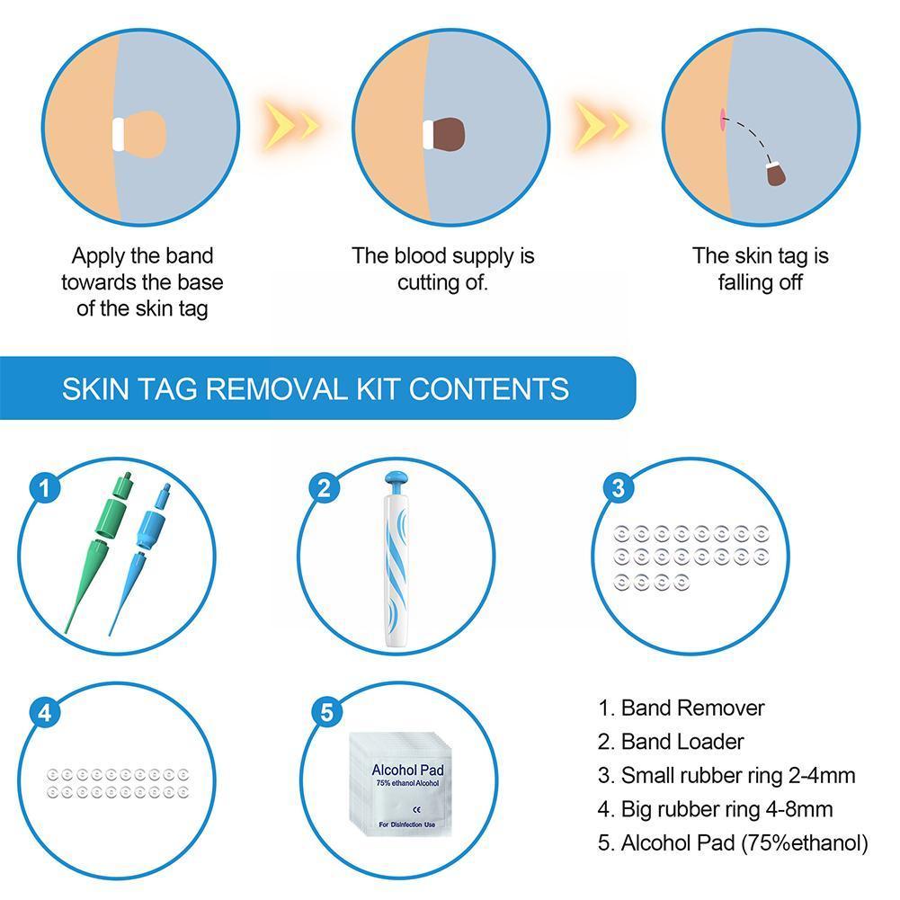 Skin Tag Remover | One Hand Micro Band Ligation Kit